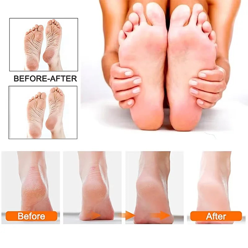 Professional Electric Foot Callus Remover for Dead Skin
